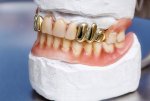 How-Much-Is-a-Gold-Tooth-Worth-1.jpg