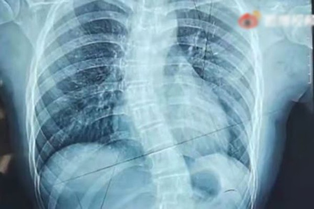  Nữ sinh 15 tuổi nhập viện vì đau lưng, cột sống biến dạng thành chữ S, tay dài tay ngắn, chân không bằng nhau chỉ vì 1 thứ rất nhiều người trẻ thường đeo trên lưng - Ảnh 1.