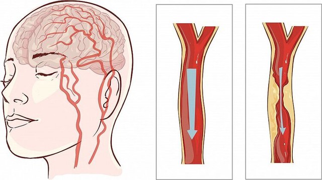 Người đàn ông 40 tuổi bị nhồi máu não, bác sĩ chỉ rõ: Ăn sáng theo 2 kiểu này thì sớm muộn mạch máu cũng bị tổn thương, tăng nguy cơ đột quỵ - Ảnh 1.