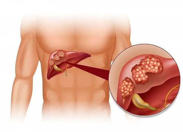 Ung thư gan thích nhất khi bạn ăn 3 loại thực phẩm, Tết này dù thích mấy cũng nên tránh xa, thấy 6 tín hiệu thì cần đi khám ngay còn kịp - Ảnh 4.