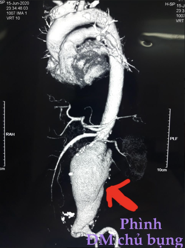 3 người suýt chết vì vỡ túi phình động mạch chủ bụng: Ai hay hút thuốc lá, ăn nhiều mỡ hãy cẩn thận! - Ảnh 1.