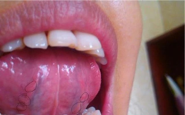 Lưỡi là thước đo sức khỏe, nếu 4 thay đổi này không xuất hiện thì chứng tỏ sức khỏe của bạn đang rất ổn định - Ảnh 2.