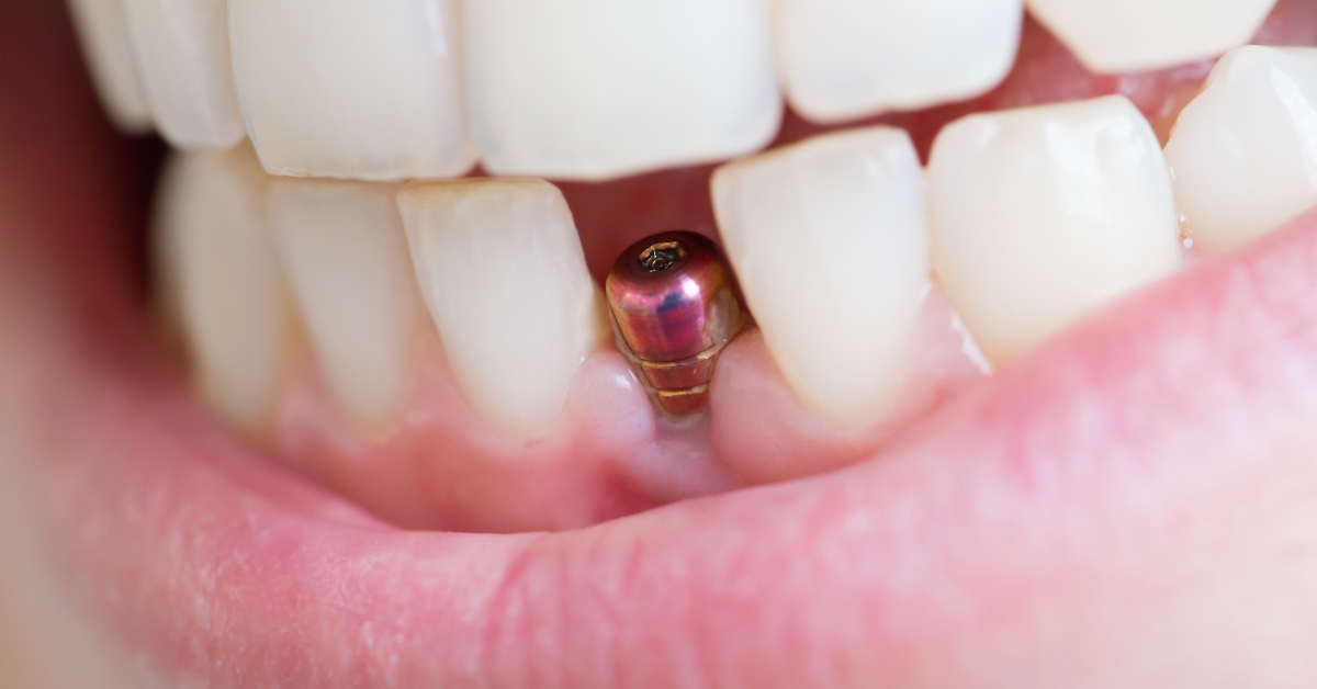 Are Dental Implants As Painful As People Think? | OMSH