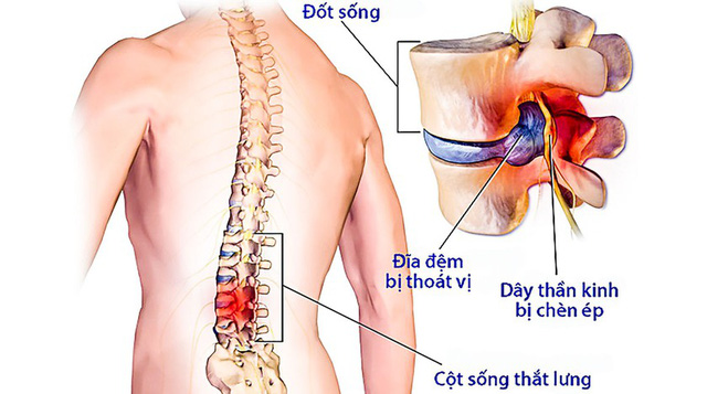 Ngồi 8 tiếng một ngày, dân công sở than trời vì đau lưng: CẢNH BÁO căn bệnh khiến cột sống có nguy cơ bị LIỆT TÀN PHẾ hoặc TEO CƠ CHI suốt đời - Ảnh 2.