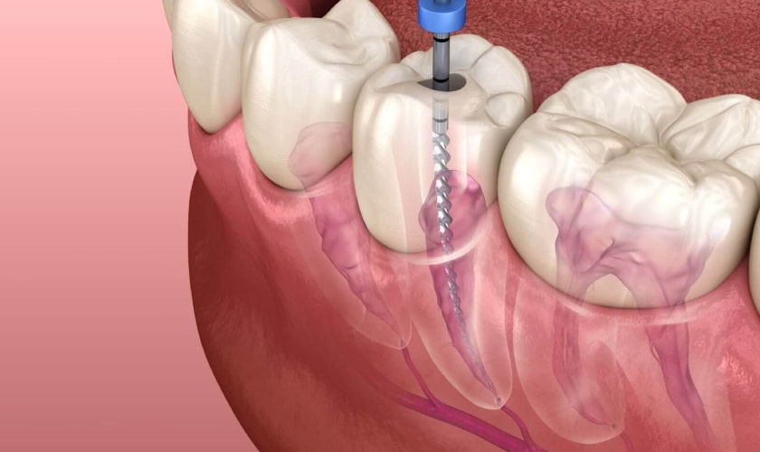 Get A Detailed Knowledge About Root Canal Treatment