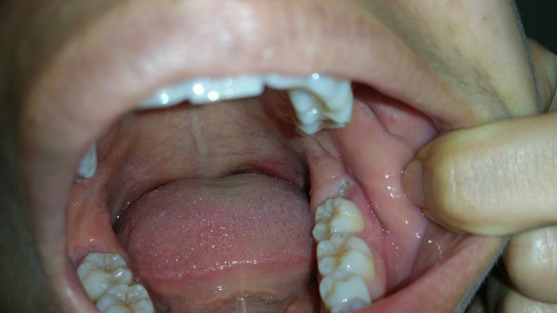Nhổ răng bị sót chân: Nguyên nhân, dấu hiệu nhận biết và cách xử lý an toàn  - nhakhoathuyanh