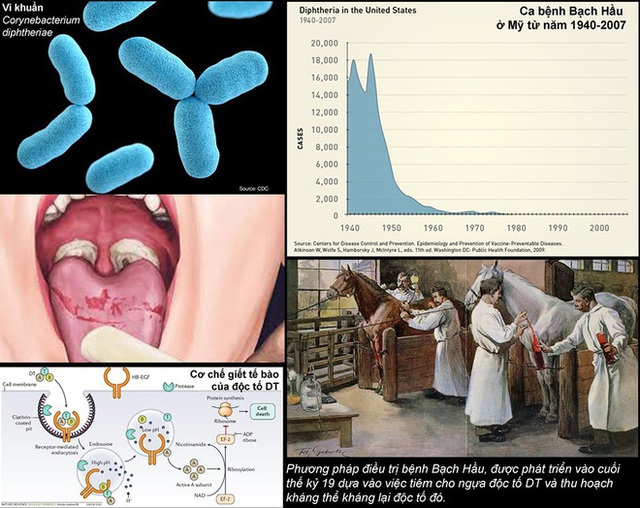TS Việt tại Mỹ: Bệnh bạch hầu và quá khứ cực kỳ đáng sợ, chỉ có 1 cách phòng bệnh duy nhất - Ảnh 1.