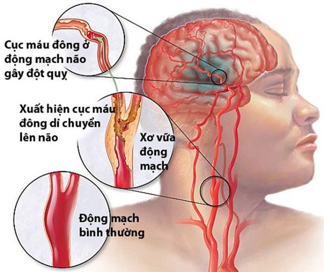  Căn bệnh gây chết não chỉ trong thời gian ngắn: Người hút thuốc lá cần bỏ ngay vì có nguy cơ cao - Ảnh 2.