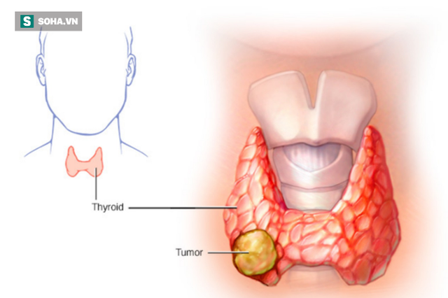 17 tuổi đã bị lùn đi 6cm trong vòng 4 năm: Căn bệnh gây loãng xương cha mẹ nên biết - Ảnh 2.