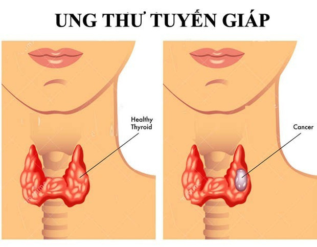 Càng nhiều người trẻ mắc ung thư tuyến giáp, bác sĩ Bệnh viện K khuyến cáo: Khi sờ hoặc nhìn thấy khối u xuất hiện vùng cổ, nên đi khám ngay - Ảnh 1.