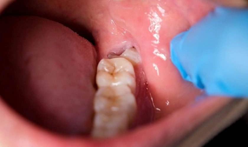 Dấu hiệu răng khôn mọc lệch: Nhận biết sớm tránh biến chứng nguy hiểm