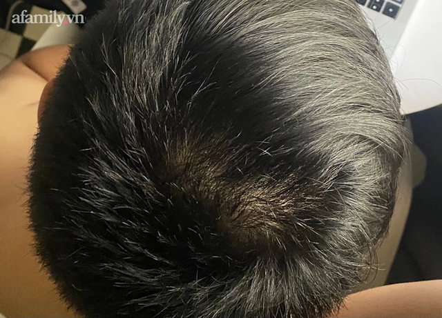 Thấy xuất hiện nhiều gàu ướt và bã nhờn trên tóc, coi chừng mắc căn bệnh ung thư dễ di căn não - Ảnh 2.