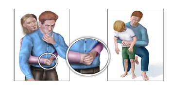 Lại một trẻ tử vong vì hóc thạch: Cơ hội duy nhất chỉ 4-5 phút, bố mẹ cần làm gì cứu con? - Ảnh 2.