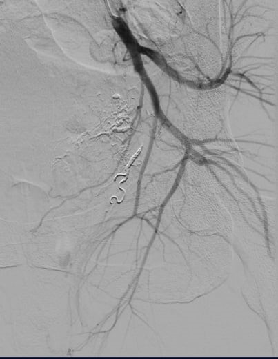 90 phút đấu trí với tử thần: Lần đầu tiên tại Việt Nam can thiệp thành công ca tổn thương động mạch trực tràng hiếm gặp - Ảnh 2.