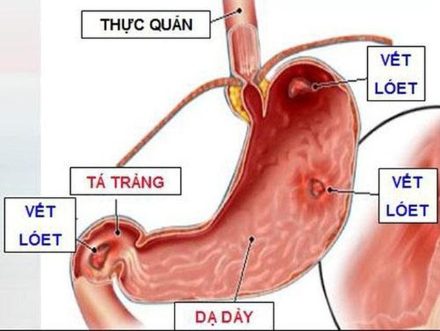  Dấu hiệu sớm, điển hình nhất báo hiệu dạ dày bị tổn thương, có bệnh: Đừng để biến chứng nguy hiểm - Ảnh 1.