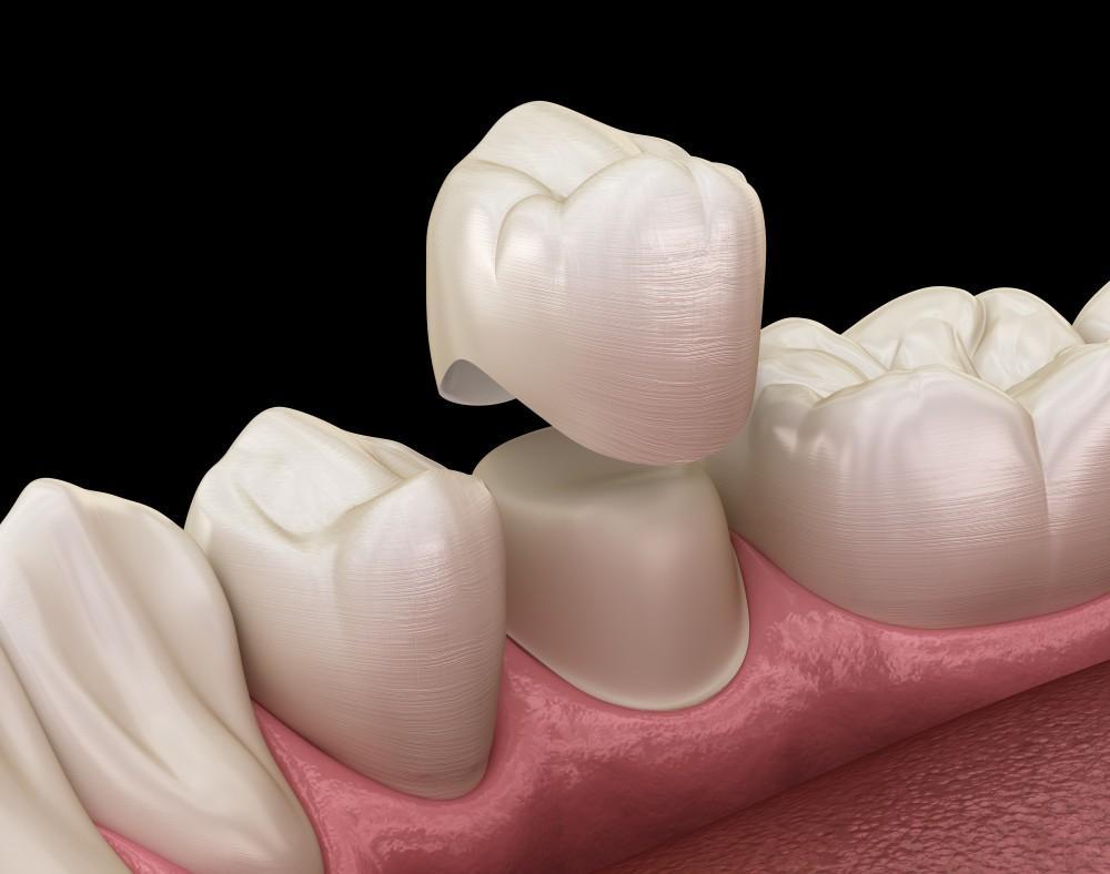 Traditional Crowns vs. Zirconia: Which Is Right for Me?: DentAlign NYC:  Dental Clinic