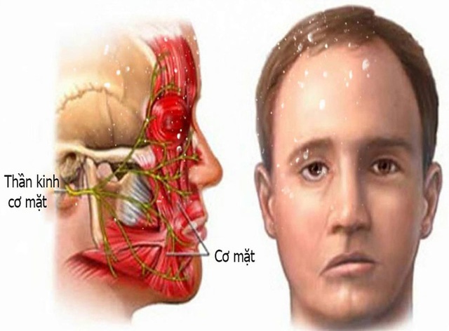 Tắm mùa đông, bệnh nhân trẻ bị liệt nửa mặt: Bác sĩ cảnh báo thêm căn bệnh do nhiễm lạnh đột ngột - Ảnh 1.