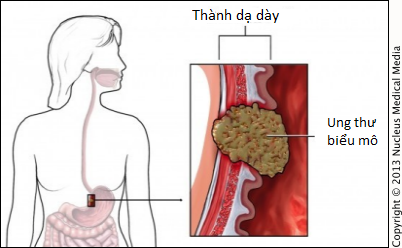 Ai có nguy cơ bị ung thư dạ dày: Nếu có một trong những yếu tố sau, cần cẩn thận! - Ảnh 1.