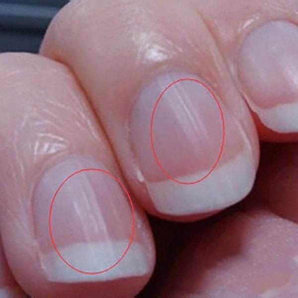 5 dấu hiệu trên móng tay cho thấy cơ thể bạn đang thiếu chất dinh dưỡng - Ảnh 1.