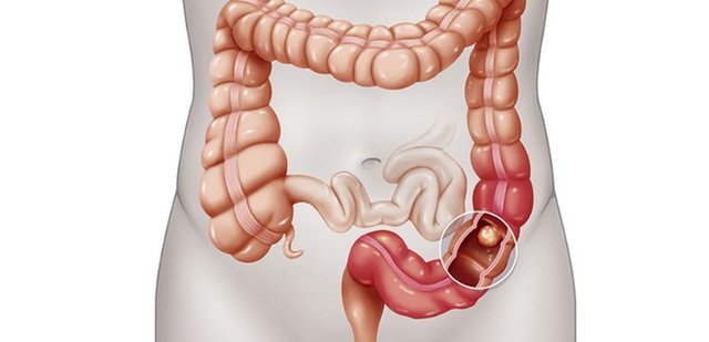 Nghiên cứu tại Mỹ: Uống 1 cốc đồ uống có đường mỗi ngày làm tăng nguy cơ ung thư đại trực tràng - Ảnh 1.