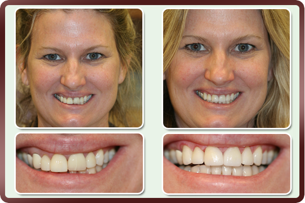 Crowns & Bridges - | Prestonwood Dental | Prestonwood Dental