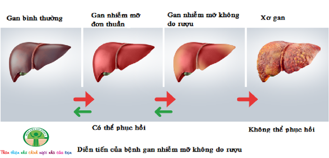 Nguyên Trưởng khoa Tiêu hóa BV Bạch Mai báo động: Có trẻ chưa lớp 1 gan đã trắng xóa mỡ - Ảnh 2.