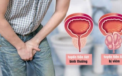 6 thực phẩm kẻ thù không đội trời chung với viêm tuyến tiền liệt: Đàn ông ăn thường xuyên thì không lo viêm nhiễm - Ảnh 1.