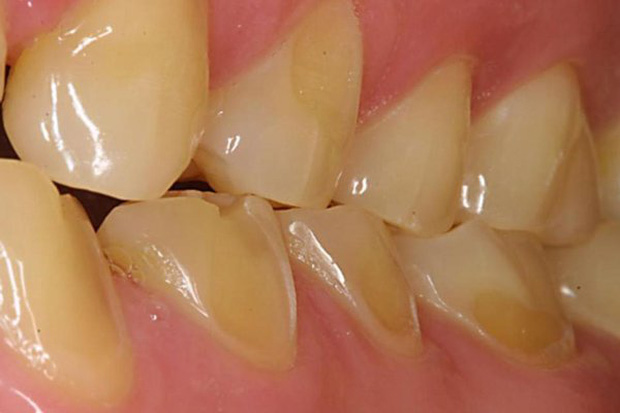 6 dấu hiệu điển hình cảnh báo nguy cơ lão hóa răng sớm mà nhiều người chẳng ngờ đến - Ảnh 1.