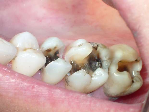 6 dấu hiệu điển hình cảnh báo nguy cơ lão hóa răng sớm mà nhiều người chẳng ngờ đến - Ảnh 2.