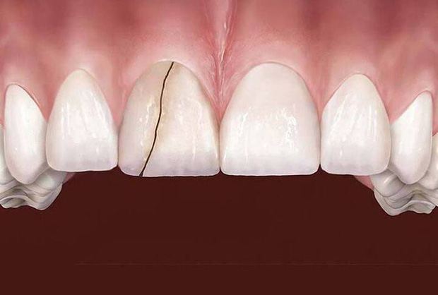 6 dấu hiệu điển hình cảnh báo nguy cơ lão hóa răng sớm mà nhiều người chẳng ngờ đến - Ảnh 4.
