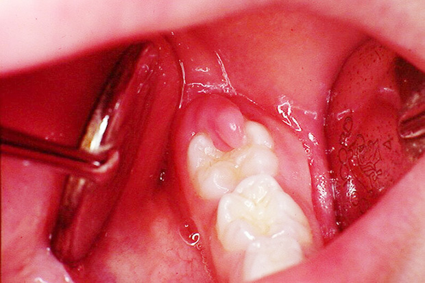 6 dấu hiệu điển hình cảnh báo nguy cơ lão hóa răng sớm mà nhiều người chẳng ngờ đến - Ảnh 5.