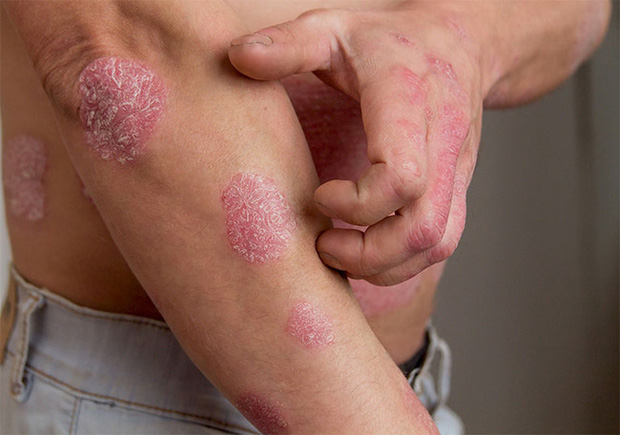 Chuyên gia da liễu tiết lộ 3 bệnh về da thường gặp vào mùa đông, muốn phòng tránh phải làm đủ 10 điều quan trọng - Ảnh 4.