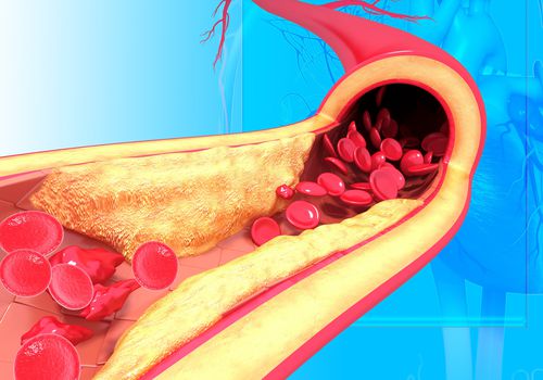 Tăng cholesterol máu cảnh báo mắc các bệnh gì: Bác sĩ BV Bạch Mai chỉ ra những căn bệnh quen thuộc, nhưng rất nguy hiểm cho sức khỏe - Ảnh 2.