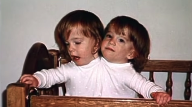 Bị chẩn đoán khó sống sót, cặp chị em sinh đôi dính liền chỉ có 2 chân khiến thế giới kinh ngạc với cuộc sống và diện mạo sau hơn 30 năm - Ảnh 2.