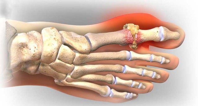Khi bạn ngủ đêm mà cơ thể có 3 biểu hiện này, axit uric đã “vượt chuẩn”, không chỉ gout, nguy cơ sỏi thận, suy thận cũng ập ngay vào - Ảnh 2.