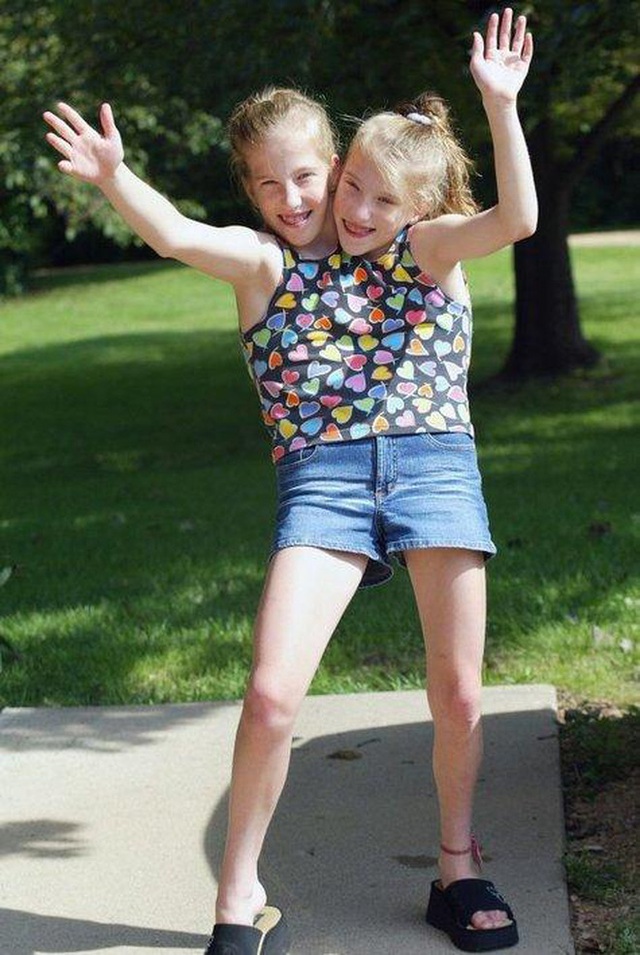 Bị chẩn đoán khó sống sót, cặp chị em sinh đôi dính liền chỉ có 2 chân khiến thế giới kinh ngạc với cuộc sống và diện mạo sau hơn 30 năm - Ảnh 3.