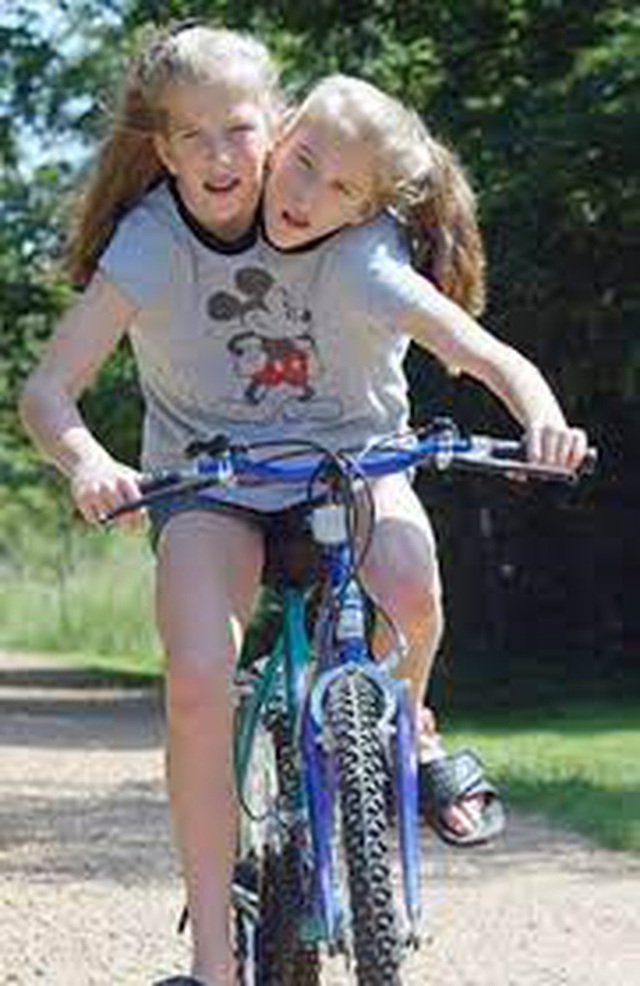 Bị chẩn đoán khó sống sót, cặp chị em sinh đôi dính liền chỉ có 2 chân khiến thế giới kinh ngạc với cuộc sống và diện mạo sau hơn 30 năm - Ảnh 4.