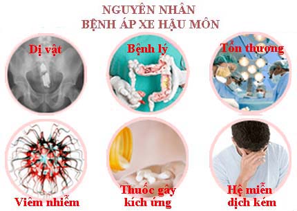 nguyên nhân gây bênh áp xe hậu môn